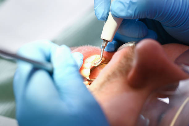 Best Emergency Wisdom Teeth Removal in Pine, AZ